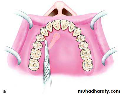 surgical aids in ortho