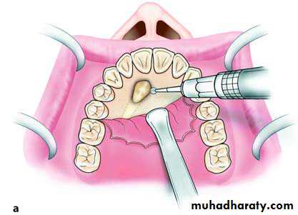 surgical aids in ortho