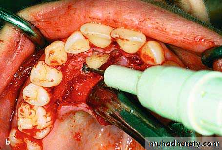 surgical aids in ortho