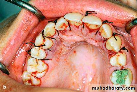 surgical aids in ortho