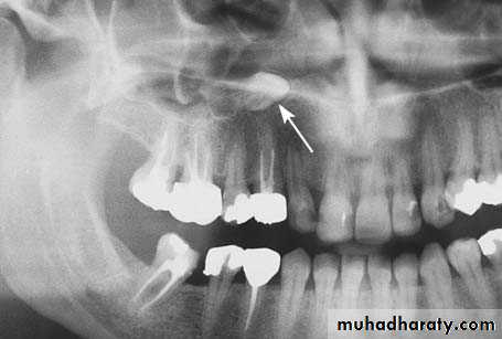 surgical aids in ortho
