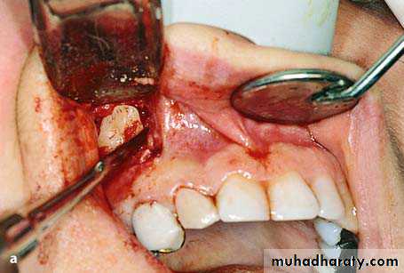 surgical aids in ortho