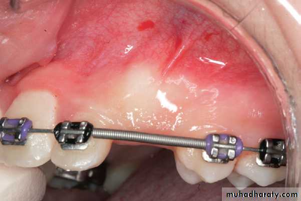 surgical aids in ortho