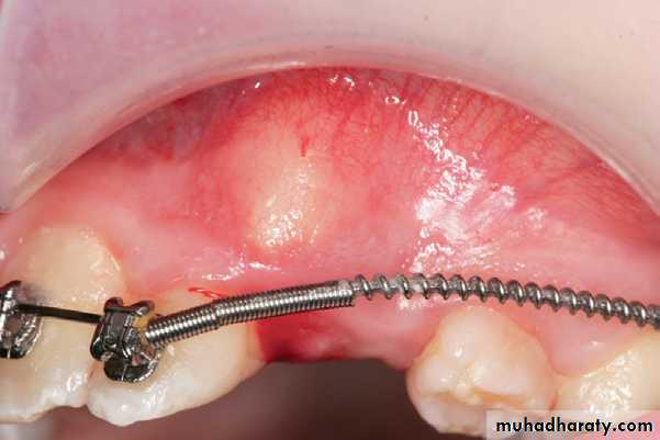 surgical aids in ortho