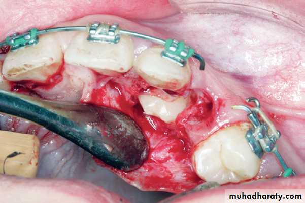 surgical aids in ortho