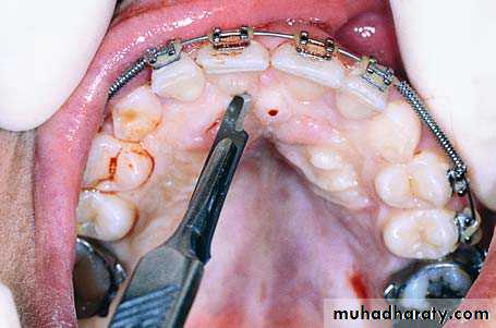 surgical aids in ortho