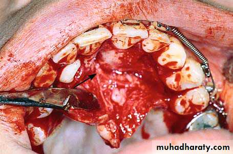 surgical aids in ortho