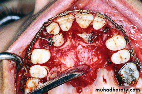 surgical aids in ortho