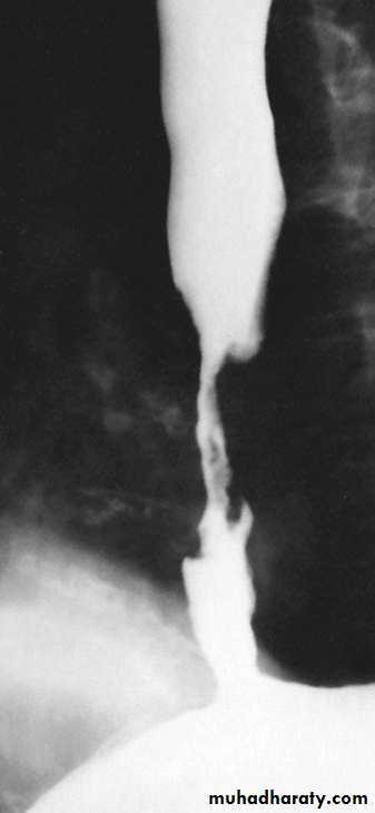 Esophagus 2