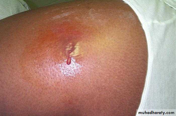 Bone infection