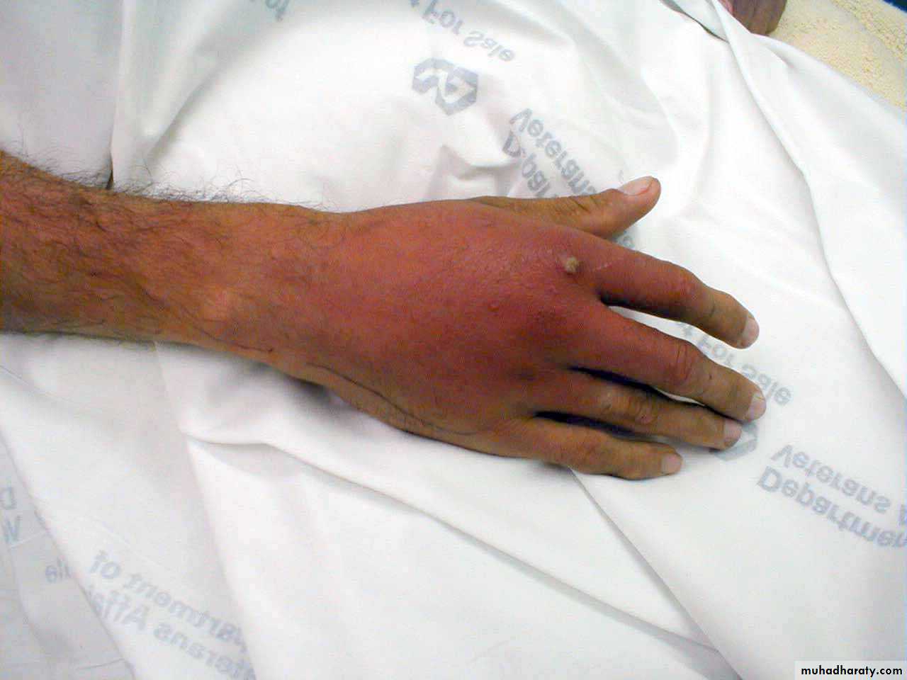 Bone infection