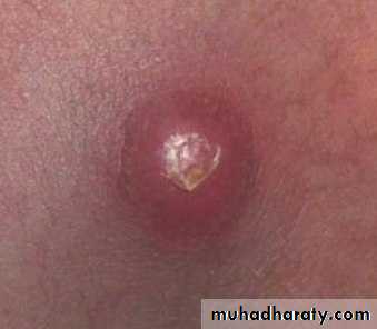 Bone infection