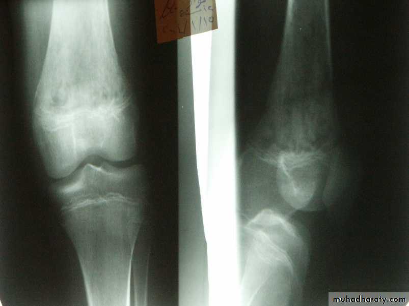 Bone infection