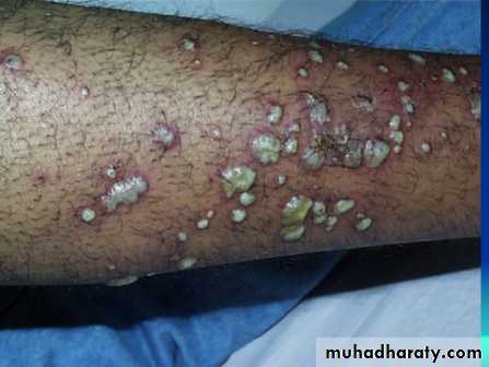 Bone infection