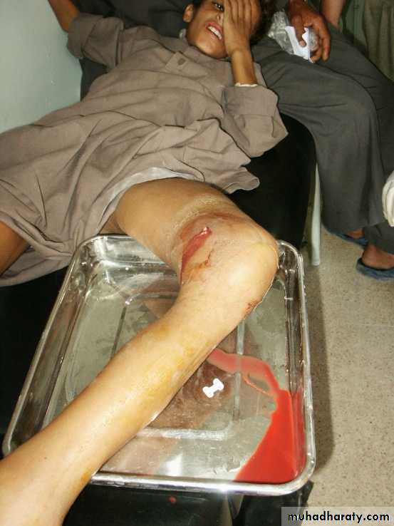 Bone infection