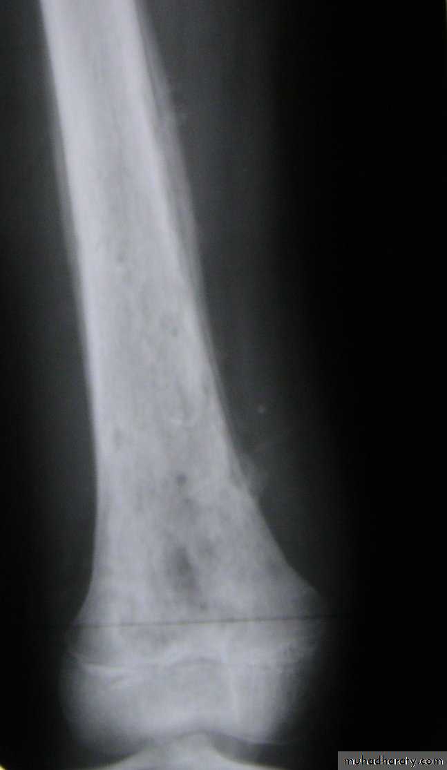 Bone infection