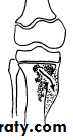 Bone infection