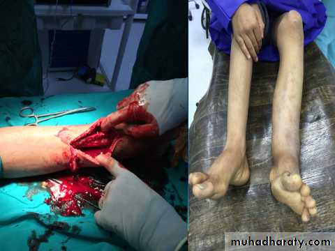 Bone infection