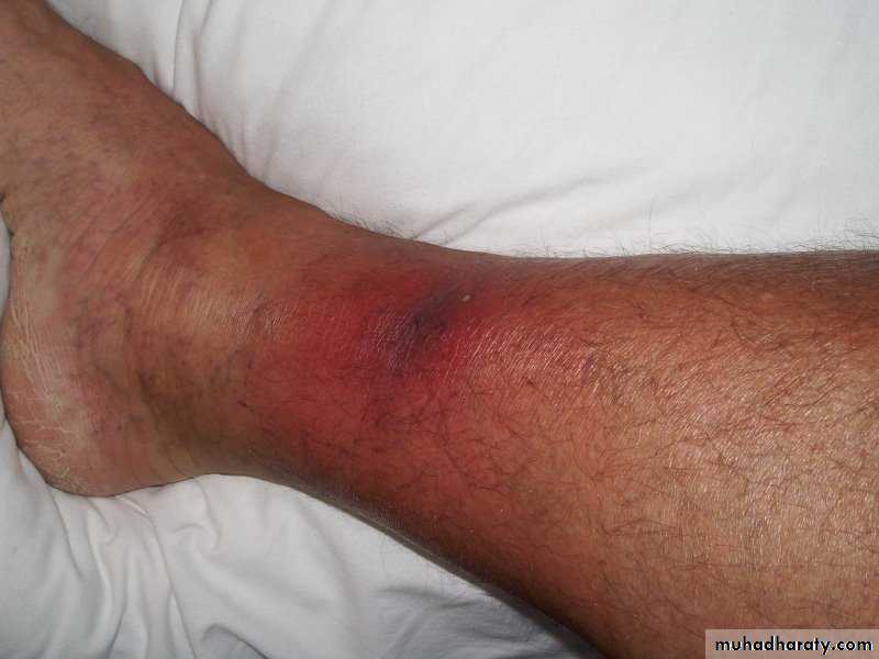 Bone infection