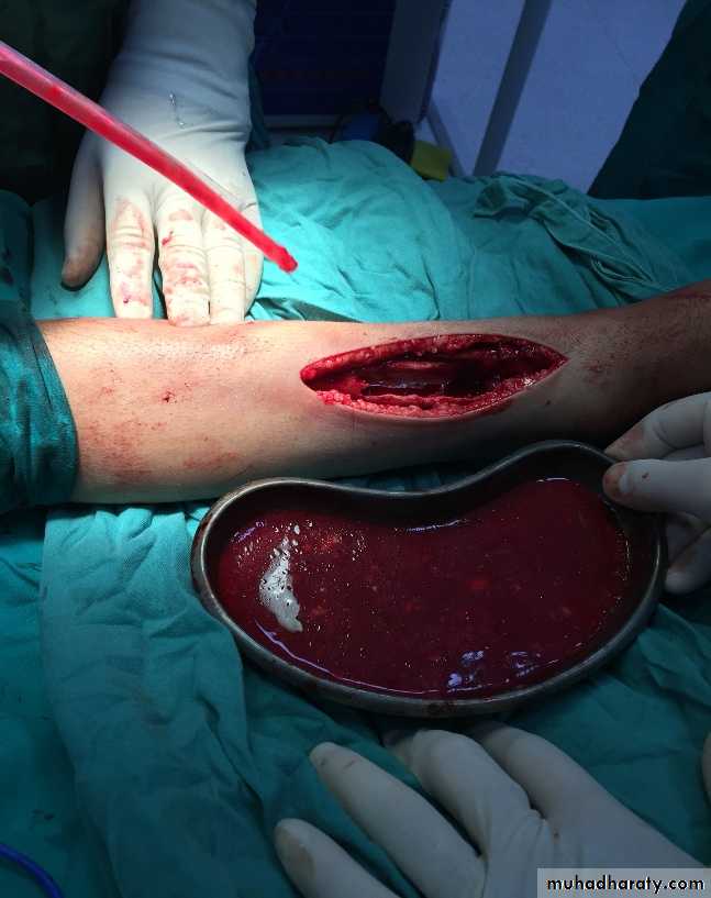 Bone infection