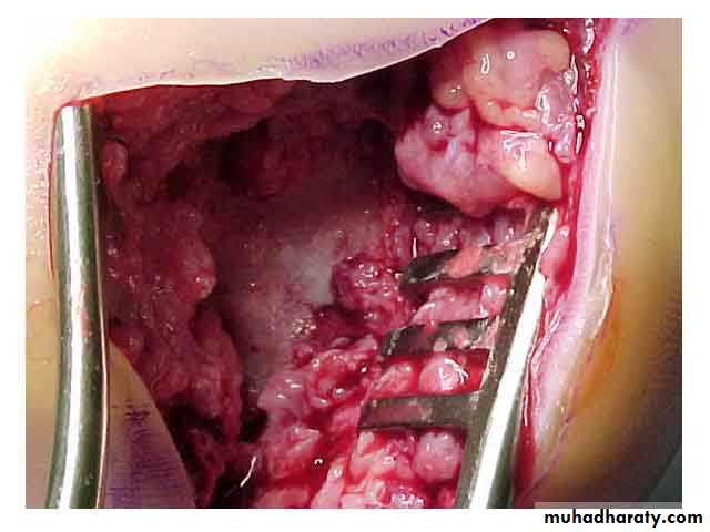 Bone infection