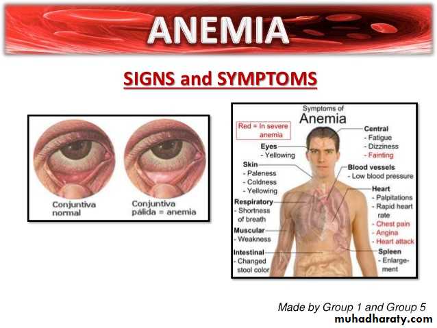 anemia