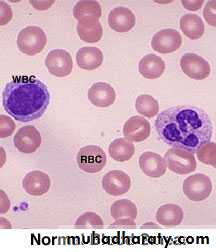 anemia
