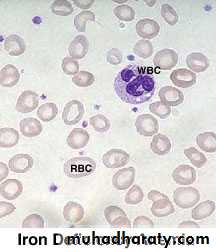 anemia