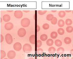 anemia
