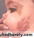 aplasic anemia