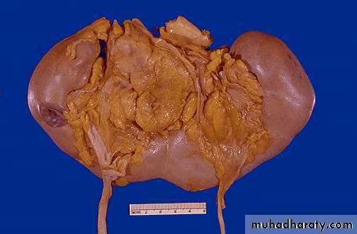 aplasic anemia