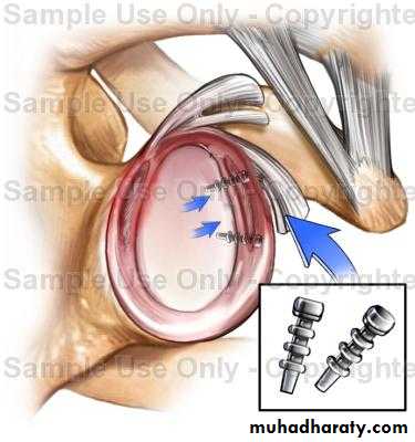 Upper Limb Orthopedic