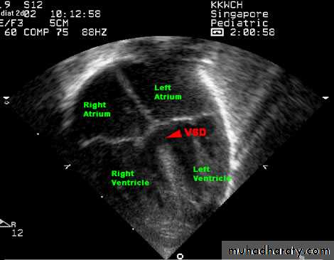 VENTRICULAR SEPTAL DEFECT