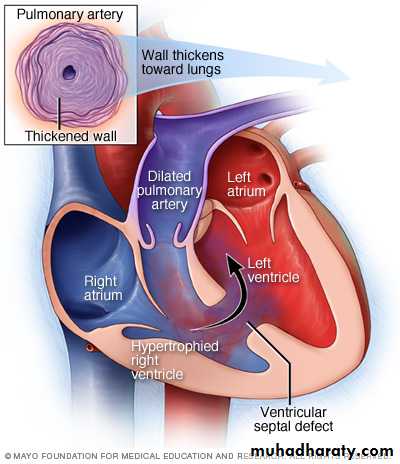 VENTRICULAR SEPTAL DEFECT