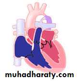 VENTRICULAR SEPTAL DEFECT