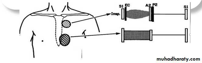 VENTRICULAR SEPTAL DEFECT