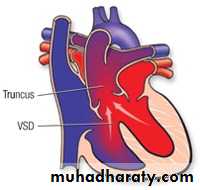 VENTRICULAR SEPTAL DEFECT