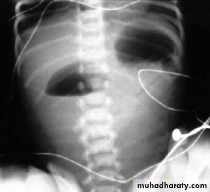 Intestinal obstruction