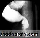 Intestinal obstruction