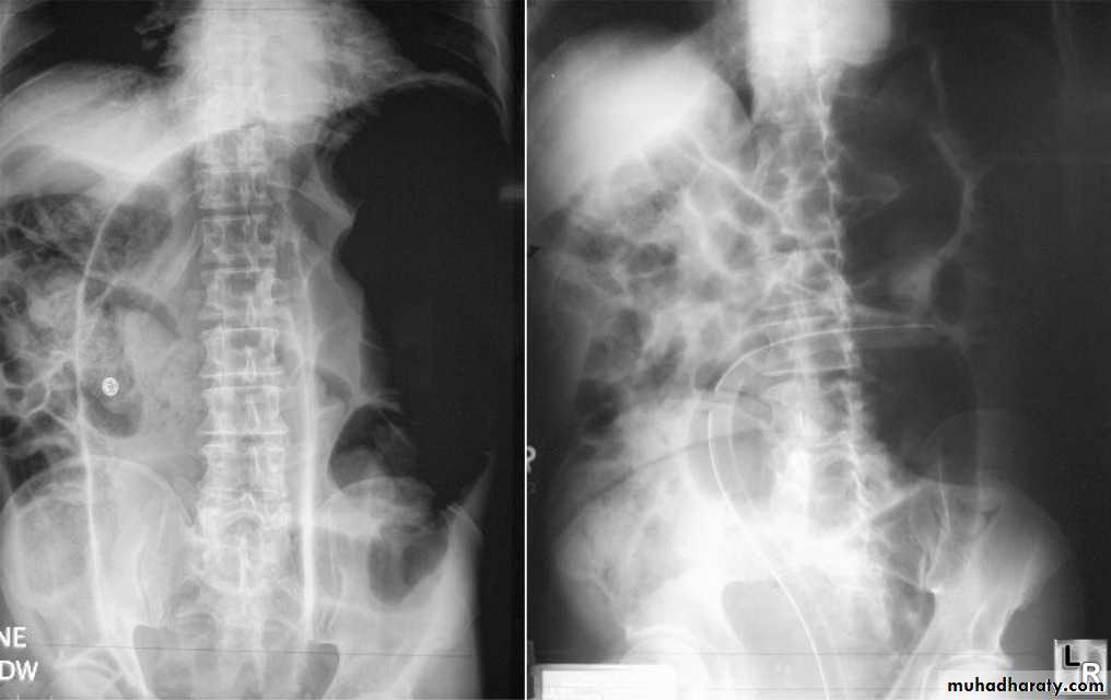 Intestinal obstruction