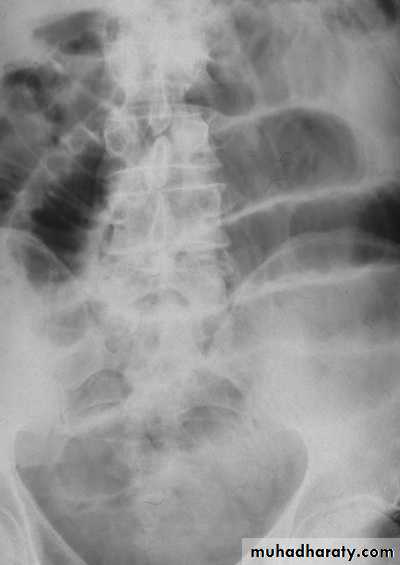 Intestinal obstruction