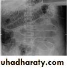 Intestinal obstruction