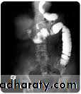 Intestinal obstruction