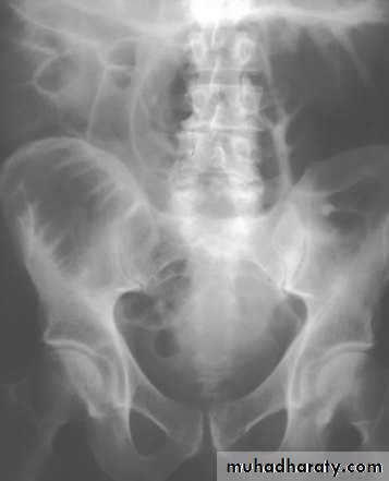 Intestinal obstruction
