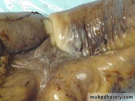 Intestinal obstruction
