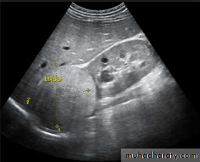 UltraSound