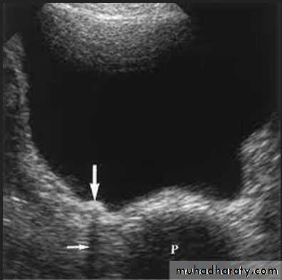 UltraSound