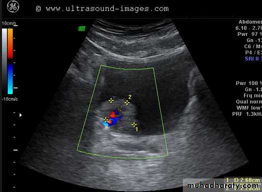 UltraSound