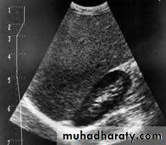 UltraSound