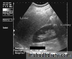 UltraSound